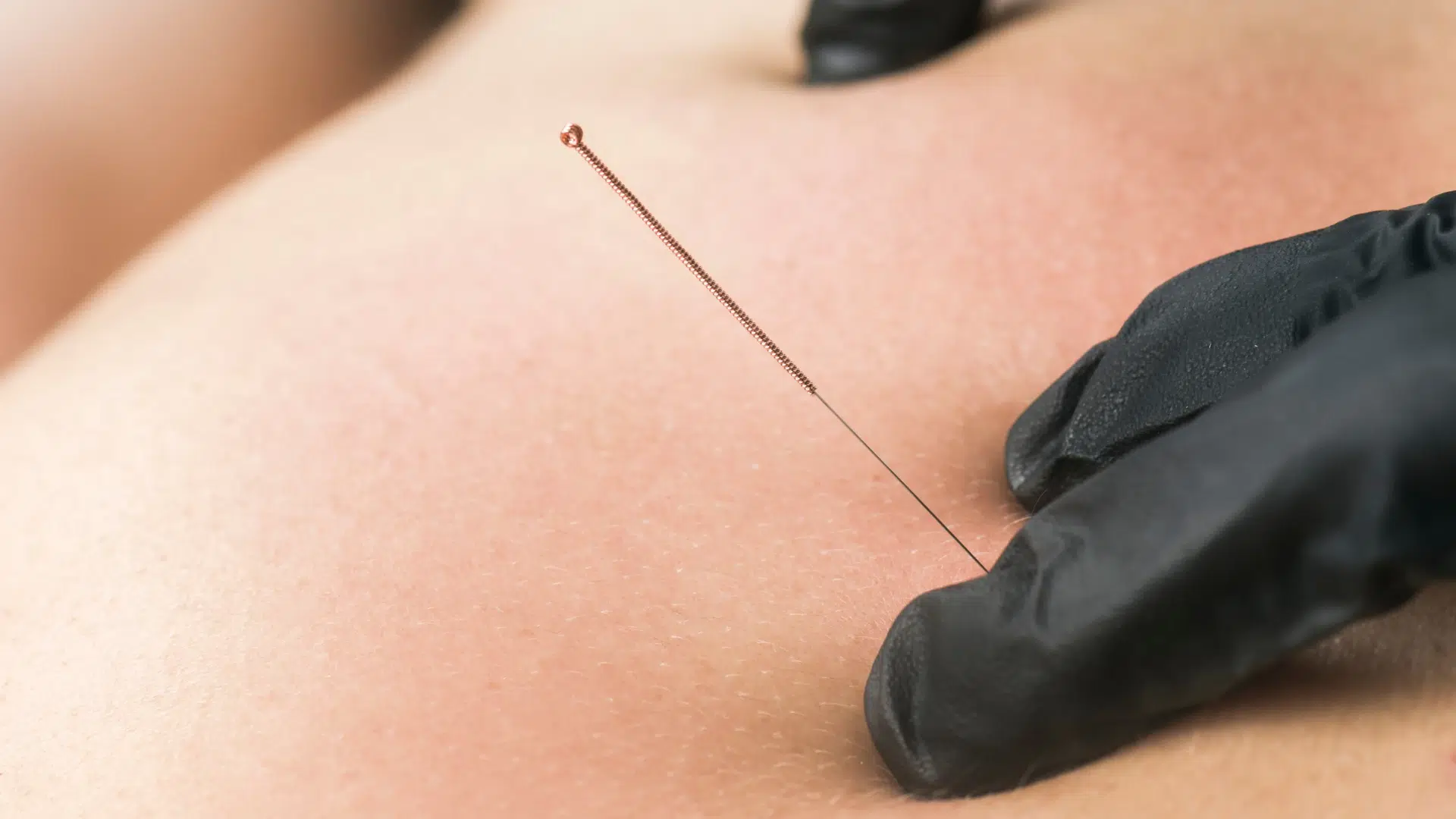 Dry needling